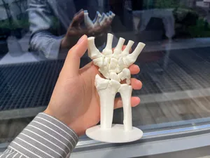 手腕骨折医学模型