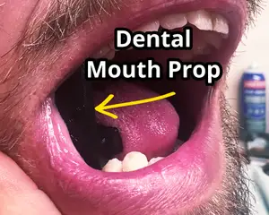 Dental Mouth Prop. Dental work bite guard
