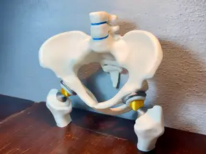 Bilateral Hip Prosthesis