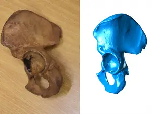 Hip bone Scan - Os Coxae (L)