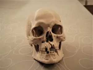 Human Skull with battle injuries Historiska Museet
