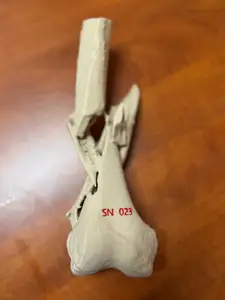 Distal femur fracture