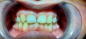 Smile Design Model