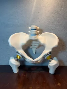 Bilateral Hip Prosthesis