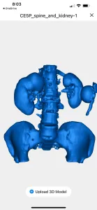 My spinal fusion and kidney cysts from CT