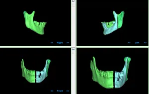 Recontruccion mandibular para panificacion quirurgica